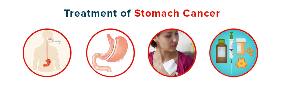 Treatment of Stomach Cancer